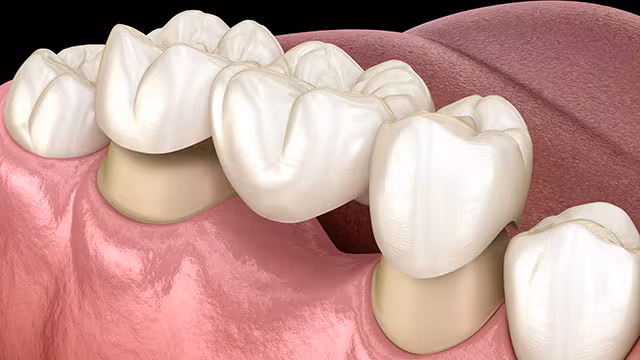 dental-crowns-and-bridge-work