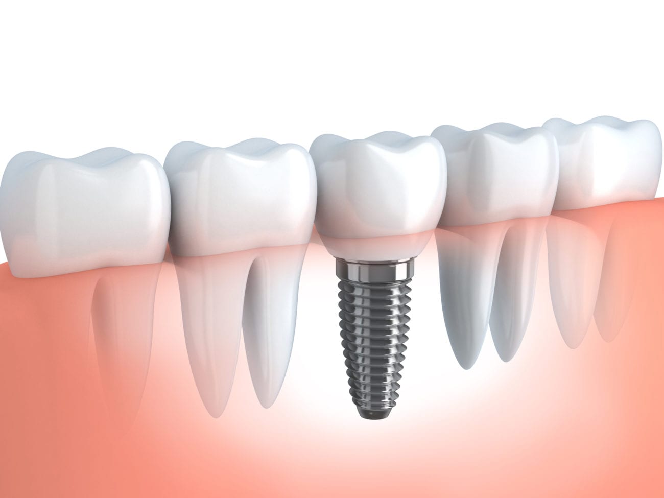 implant 6