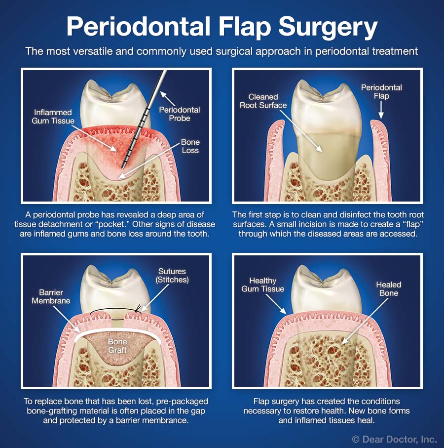 periodontal-flap-surgery 1