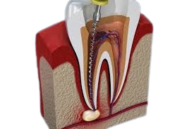 root_canal_treatment-removebg-preview