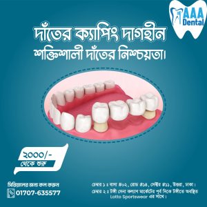 দাঁতের ক্যাপিং